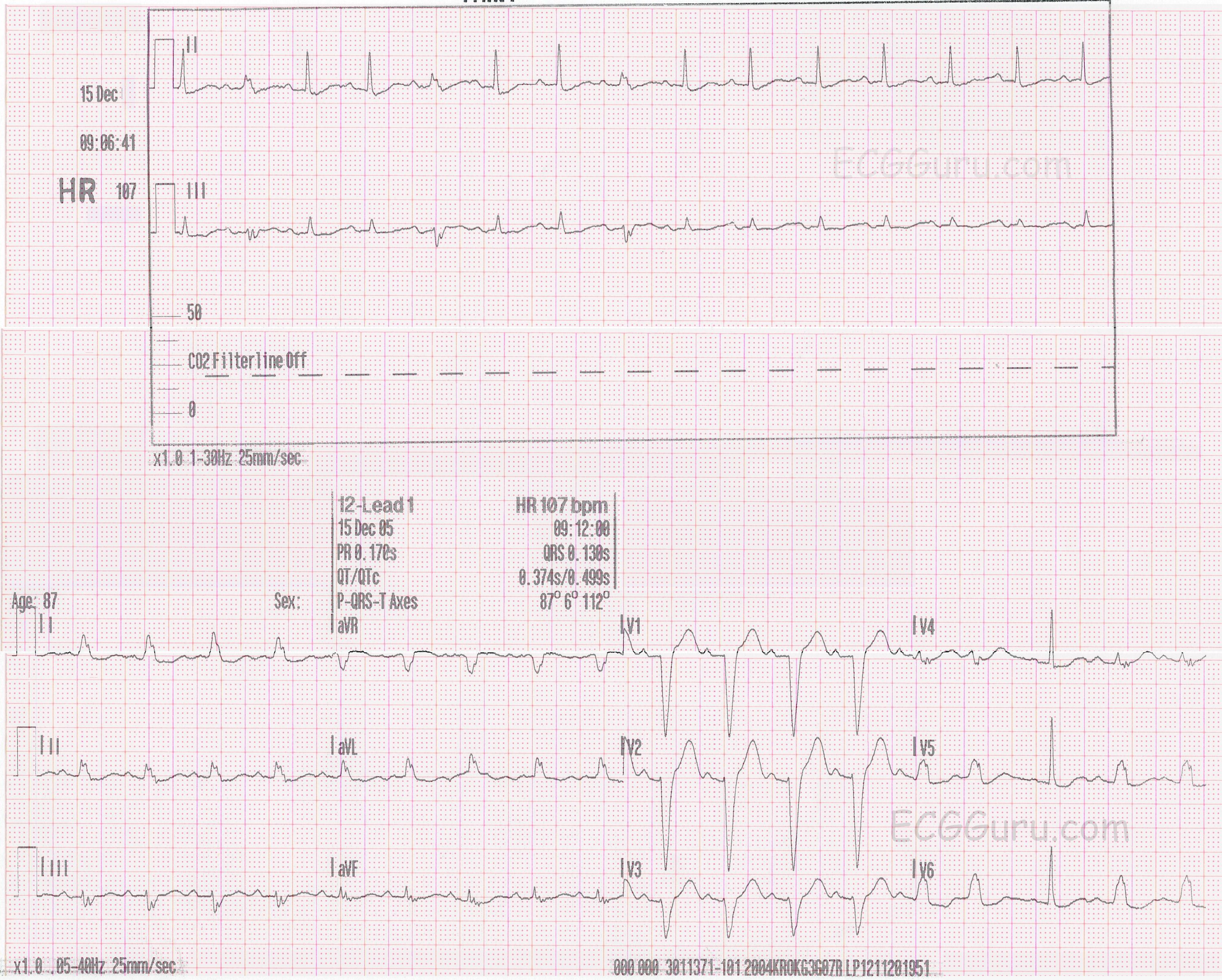 ecg-challenge-changing-qrs-morphology-ecg-guru-instructor-resources